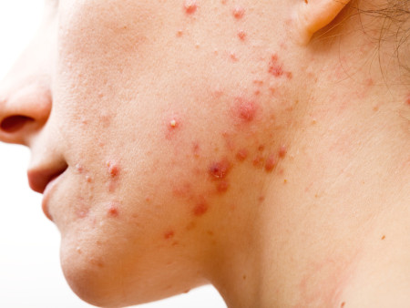 Acné-behandeling Laserpeel